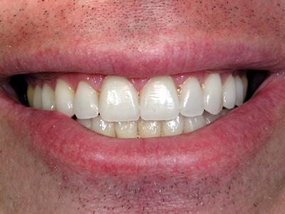 Porcelain Veneers in Woodmere
