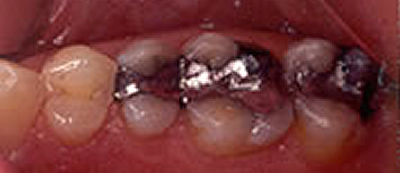Dental Fillings in Woodmere