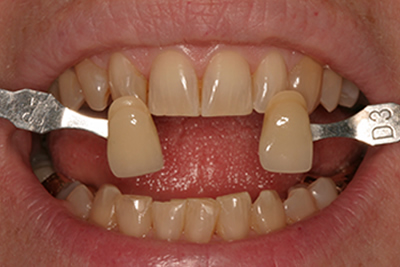 Teeht Whitening in Woodmere