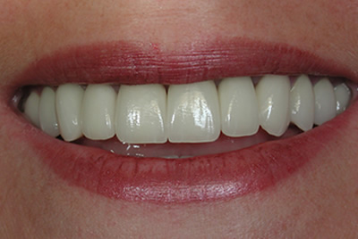 Ceramic Dental Crowns in Woodmere