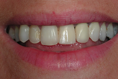 Ceramic Dental Crowns in Woodmere