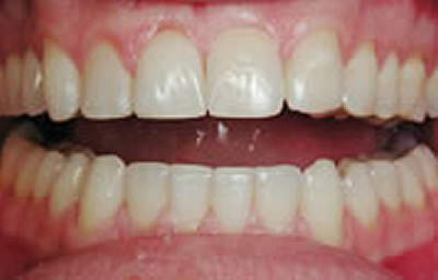 Invisalign Dentist in Woodmere