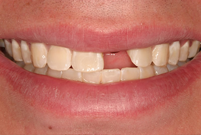 Woodmere Dental Implants Dentist