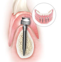Mini Dental Implants Dentist in Woodmere