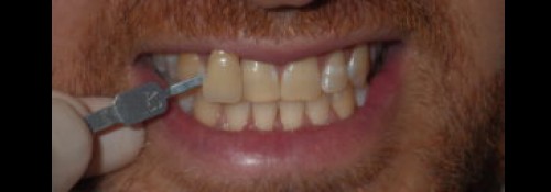 Teeth Whitening Dentist in Woodmere