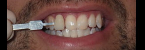 Teeth Whitening in Woodmere