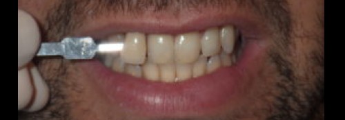 Woodmere Teeth Whitening Dentist